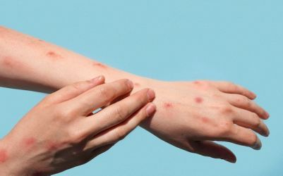866 Orang di Afrika Meninggal karena Mpox, CDC: Epidemi Tak Terkendali