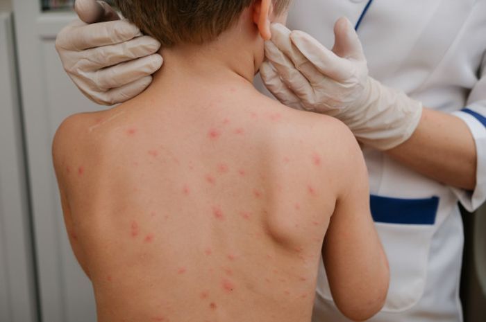 Atasi Virus Varicella atau Cacar Air pada Anak, Ini Solusi Dinkes Pekanbaru